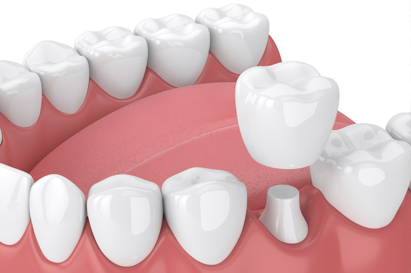 Dental Crowns in Cincinnati