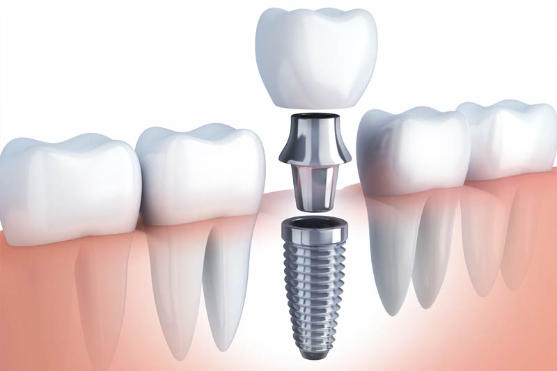 Implants Dentist in Cincinnati