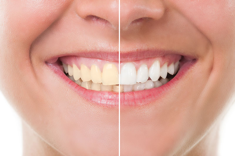 Teeth Whitening in Cincinnati